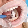 Оптра Гейт - OptraGate - ретрактор для губ, регуляр